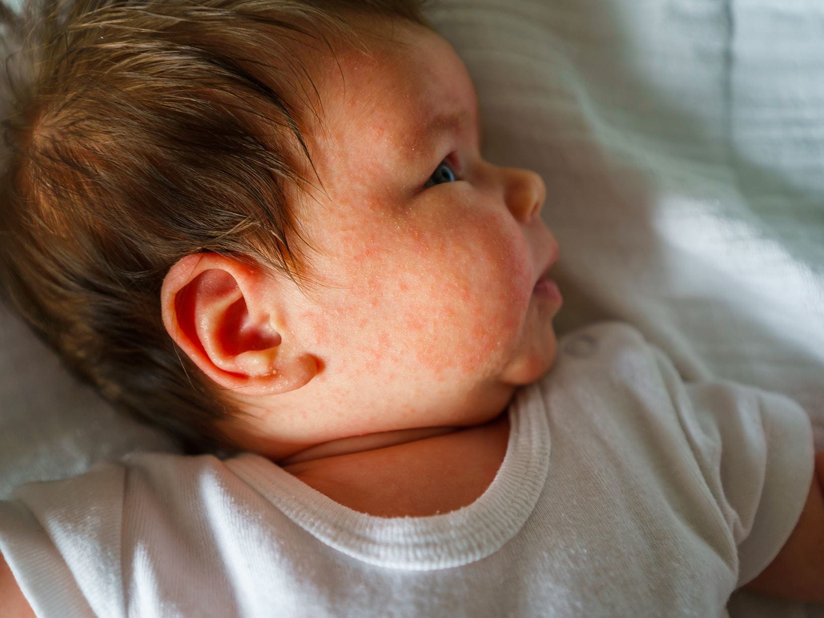 sudamina neonato