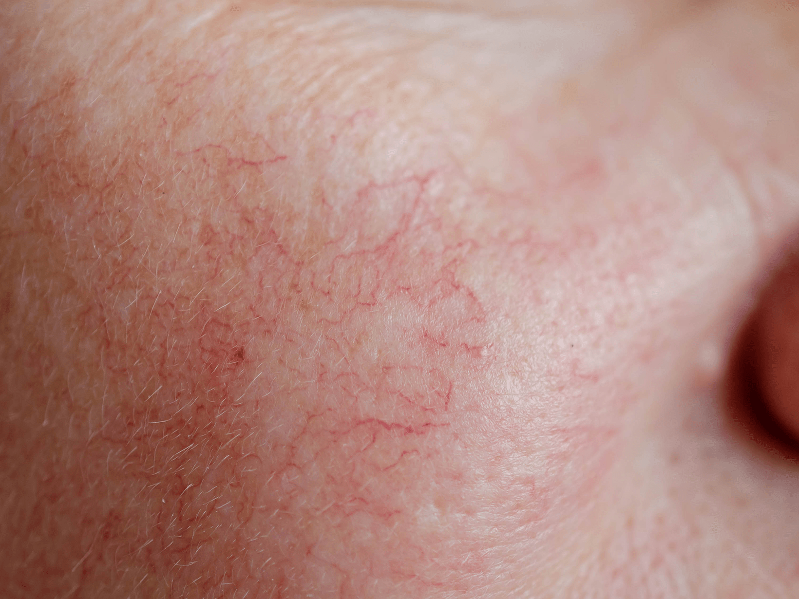 irritazione cutanea
